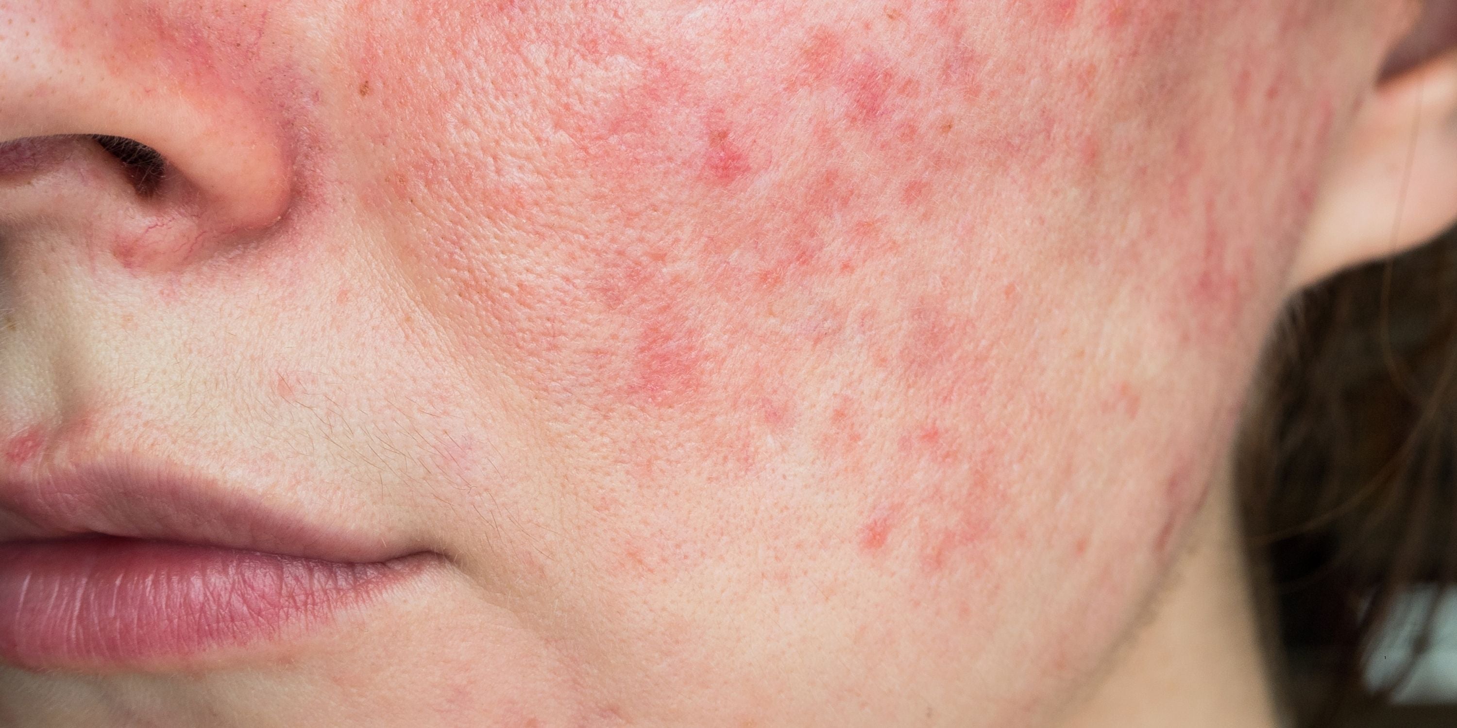 Is It Acne or Rosacea? Understanding Redness Prone Skin - Raven Botanicals